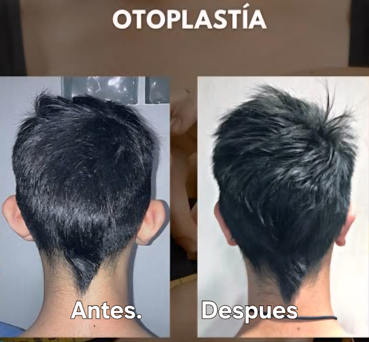 Resultado Otoplastia 5